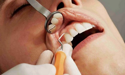 Dental Cleaning