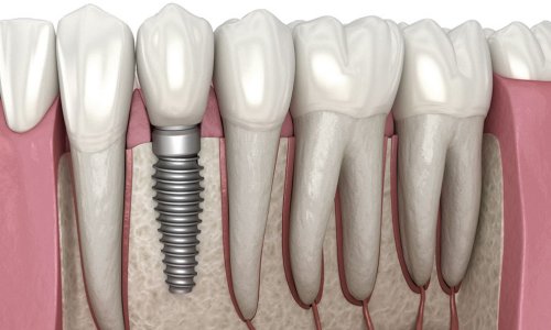 Dental Implants